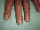 船橋　ユーカリ　クリニック　皮膚科　形成外科　爪白癬　水虫