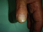 船橋　ユーカリ　クリニック　皮膚科　形成外科　爪白癬　水虫