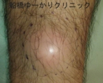 船橋　しこり　腫瘍　腫瘤　がん　肉腫