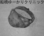 船橋　しこり　腫瘍　腫瘤　がん　肉腫