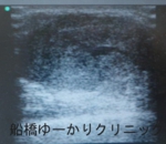 船橋　しこり　腫瘍　腫瘤　がん　肉腫