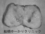 船橋　しこり　腫瘍　腫瘤　がん　肉腫