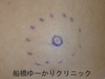 千葉　船橋　しこり　腫瘍　腫瘤