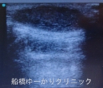 千葉　船橋　しこり　腫瘍　腫瘤