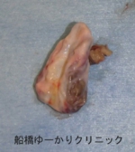 千葉　船橋　しこり　腫瘍　腫瘤