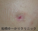 千葉　船橋　しこり　腫瘍　腫瘤