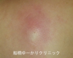 千葉　船橋　しこり　腫瘍　腫瘤　化膿　おでき　粉瘤