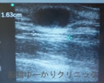 千葉　船橋　しこり　腫瘍　腫瘤　化膿　おでき　粉瘤