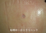 千葉　船橋　しこり　腫瘍　腫瘤　化膿　おでき　粉瘤