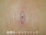 千葉　船橋　しこり　腫瘍　腫瘤　化膿　おでき　粉瘤