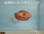 千葉　船橋　しこり　腫瘍　腫瘤　化膿　おでき　粉瘤