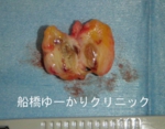 千葉　船橋　しこり　腫瘍　腫瘤　化膿　おでき　粉瘤