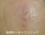 千葉　船橋　しこり　腫瘍　腫瘤　化膿　おでき　粉瘤