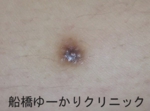 千葉　船橋　しこり　腫瘍　腫瘤　虫刺され
