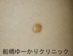 船橋　しこり　傷痕　ケロイド