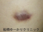 船橋　しこり　傷痕　ケロイド
