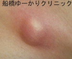 船橋　しこり　傷痕　ケロイド