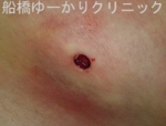船橋　しこり　傷痕　ケロイド