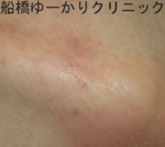 船橋　しこり　傷痕　ケロイド