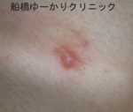船橋　しこり　傷痕　ケロイド