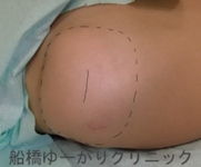 船橋　しこり　腫瘍　腫瘤　肩　脂肪