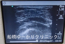船橋　しこり　腫瘍　腫瘤　肩　脂肪