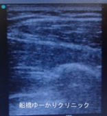 船橋　しこり　腫瘍　腫瘤　腕　脂肪