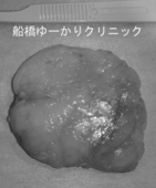船橋　しこり　腫瘍　腫瘤　腕　脂肪