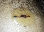 船橋　ユーカリ　クリニック　形成外科　しこり　腫瘍　腫瘤　摘出　手術　傷痕　きず　傷跡