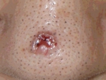 船橋　皮膚がん　ゆーかりクリニック
