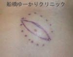 千葉　船橋　しこり　腫瘍　腫瘤