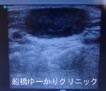 千葉　船橋　しこり　腫瘍　腫瘤