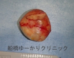 千葉　船橋　しこり　腫瘍　腫瘤