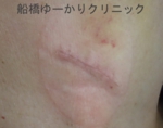 千葉　船橋　しこり　腫瘍　腫瘤