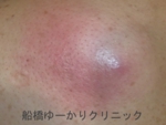 千葉　船橋　しこり　腫瘍　腫瘤　化膿　おでき　粉瘤