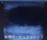 千葉　船橋　しこり　腫瘍　腫瘤　化膿　おでき　粉瘤