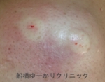 千葉　船橋　しこり　腫瘍　腫瘤　化膿　おでき　粉瘤
