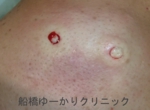 千葉　船橋　しこり　腫瘍　腫瘤　化膿　おでき　粉瘤