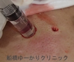 千葉　船橋　しこり　腫瘍　腫瘤　化膿　おでき　粉瘤