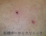 千葉　船橋　しこり　腫瘍　腫瘤　化膿　おでき　粉瘤