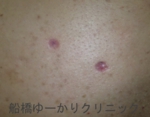 千葉　船橋　しこり　腫瘍　腫瘤　化膿　おでき　粉瘤