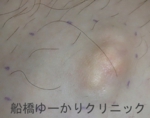 千葉　船橋　しこり　腫瘍　腫瘤　石灰化　カルシウム