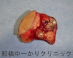 千葉　船橋　しこり　腫瘍　腫瘤　石灰化　カルシウム