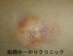 千葉　船橋　しこり　腫瘍　腫瘤　石灰化　カルシウム