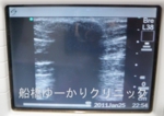 千葉　船橋　しこり　腫瘍　腫瘤　石灰化　カルシウム