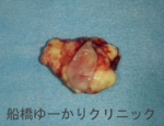 千葉　船橋　しこり　腫瘍　腫瘤　石灰化　カルシウム