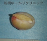 千葉　船橋　しこり　腫瘍　腫瘤