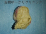 千葉　船橋　しこり　腫瘍　腫瘤