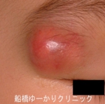 船橋　しこり　腫瘍　腫瘤　まぶた