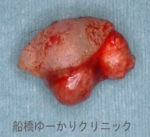 船橋　しこり　腫瘍　腫瘤　まぶた